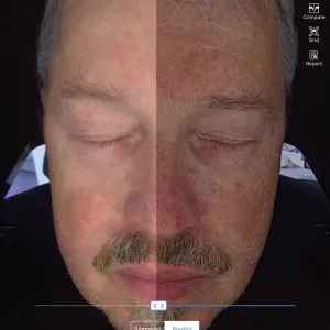 Skin Analyser - Diagnostic de Peau